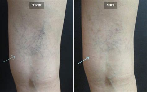 Laser Vein Removal Before And After Pictures