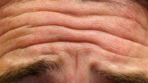 Deep Forehead Wrinkles Link To Cardiovascular Disease Bt