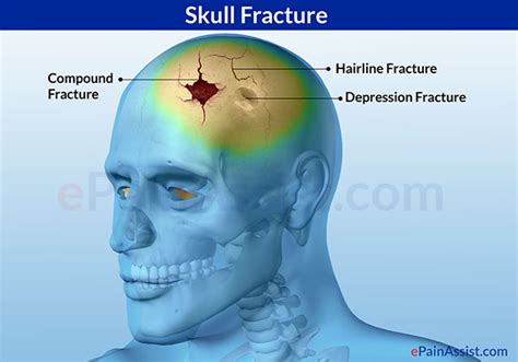 Skull Fracturetypessymptomsinvestigationstreatment Rest Elevation