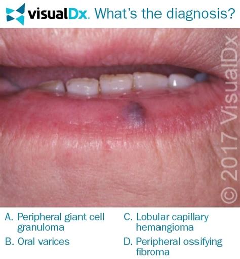 Woman Asks Dentist About Purple Lip Nodule Lets Diagnose Visualdx