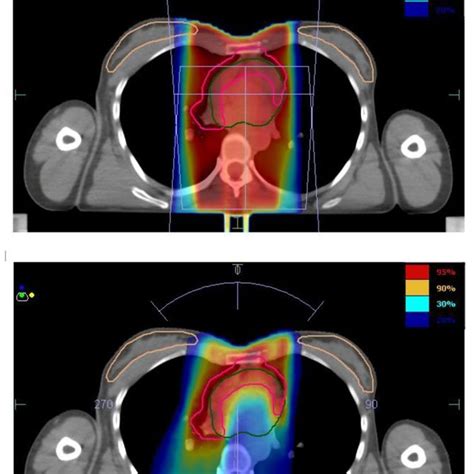 Involved Site 3d Conformal Radiotherapy On The Top Vs Download
