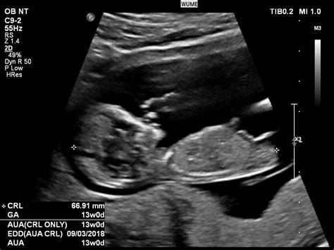 Rule out an ectopic pregnancy(when a fertilized egg implants outside of the uterus) while most women usually have two ultrasounds—one around 12 weeks and one around 20 weeks—your doctor may perform just one.2 if only one ultrasound is performed, it will take place around the 20th week of pregnancy to:1 1. Ultrasound In Pregnancy - Women's Ultrasound Melbourne
