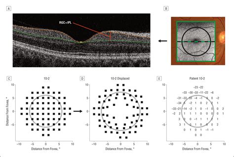 retinal ganglion cell layer thickness and local visual field sensitivity in glaucoma jama