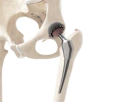Total Hip Replacement Anterior Approach And Benefits