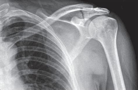 Old Healed Fracture Of Right Scapula And Clavicle