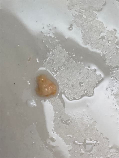 Had My Wisdom Teeth Removed 3 Days Ago And This One Was Hurting The