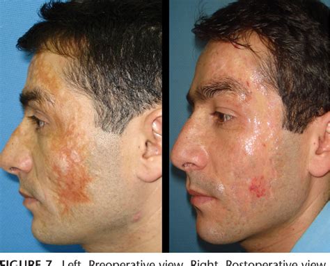 Treatment Of Facial Burn Scars With Co2 Laser Resurfacing And Thin Skin