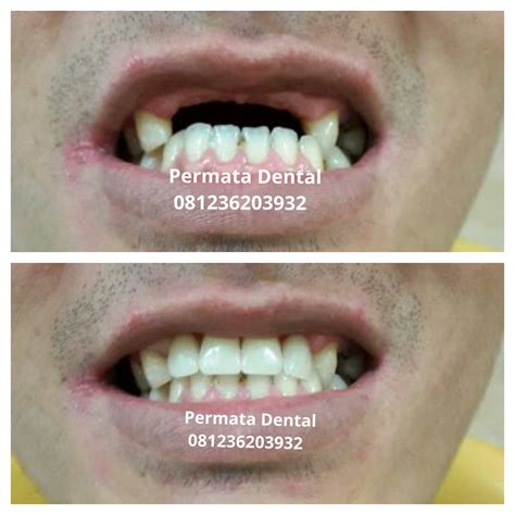 Harga pasang untuk gigi palsu permanen jenis ini bisa mencapai rp. Ahli Gigi Bali | Permata Dental: Pasang Gigi Palsu Lepas ...