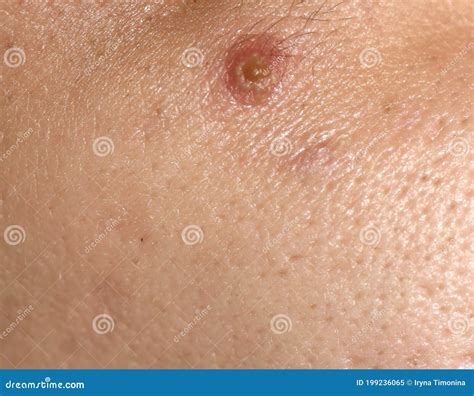 Inflamed Skin Acne On The Face Stock Image Image Of Dermis