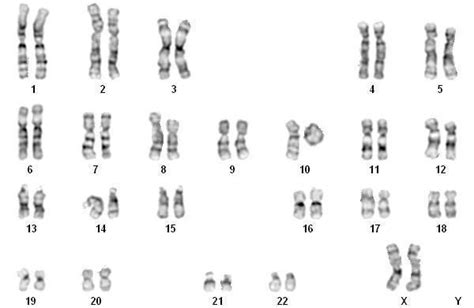 Chromosome R10p153q2612 In A Newborn Child Case Report