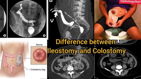 Whats The Difference Between Ileostomy And Colostomy Ctscan Whats The