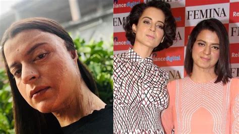 Had To Go Through Therapy Kangana Ranaut Recollects Acid Attack