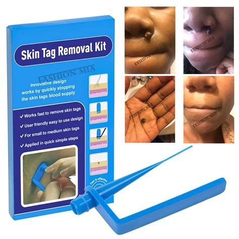 new 1set skin tag remover kit for remove warts body skin care wart treatment face skin tag