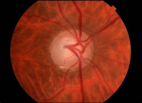 Corneal Hysteresis Predictive Of Neuroretinal Rim Loss In Glaucoma