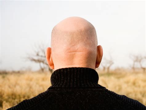 Scientists Have Made A Major Breakthrough In The Cure For Baldness