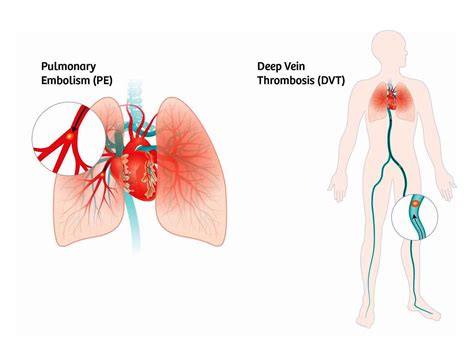 Novas Orienta Es Sobre Embolia Pulmonar Portal Cirurgia Vascular