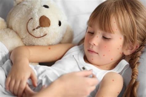 Scarlatina La Copii Cauze Tratament și Cum Se Transmite Scarlatina La