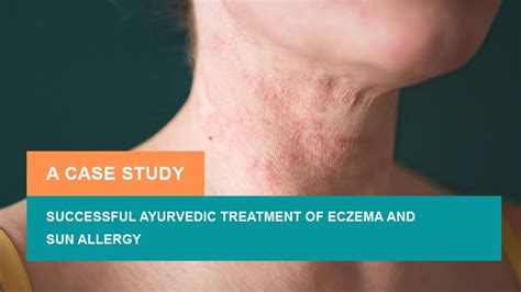 Successful Ayurvedic Treatment Of Eczema And Sun Allergy A Case Study