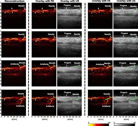 photoacoustic pa imaging with needle insertions into human fingers in download scientific