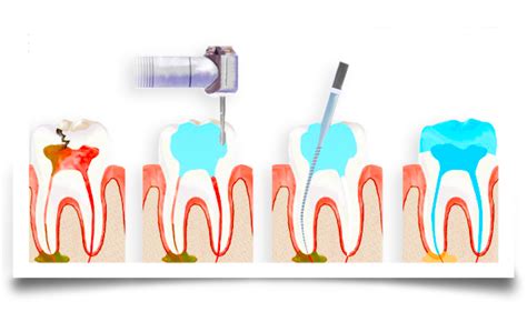 Root Canal Treatment - Emergency Root Canal Treatment ...
