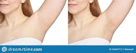 Girl Underarm White Woman Armpit Before And After Epilation Stock