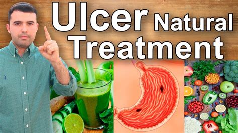 Homemade Treatment For Gastric Ulcer Homemade Ftempo