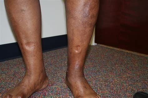 Leg Swelling Or Medical Term Edema Vein Specialists Of The Carolinas