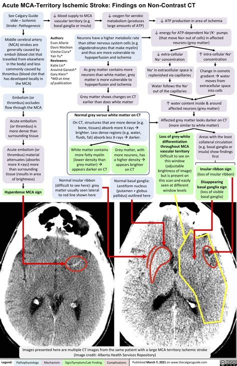 Acute Mca Territory Ischemic Stroke Findings On Non Contrast Ct