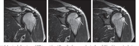 Figure 3 From Latissimus Dorsi Tendon Transfer With GraftJacket