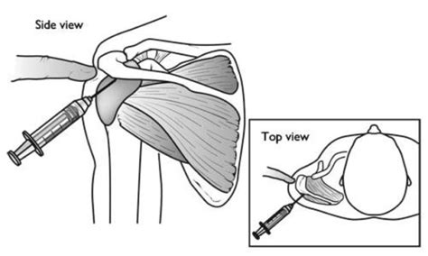 Arthroscopic Subacromial Decompression For Impingement Syndrome Of The