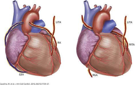 The Choice Of Conduits In Coronary Artery Bypass Surgery Journal Of
