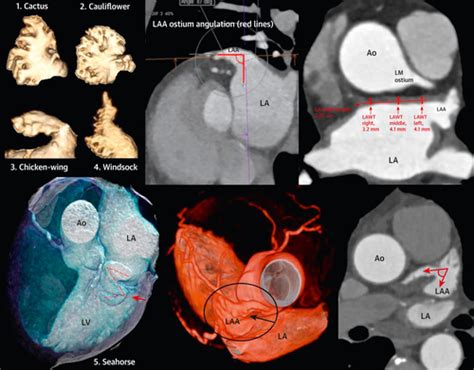Left Atrial Appendage Morphology Is Associated With Cryptogenic Stroke