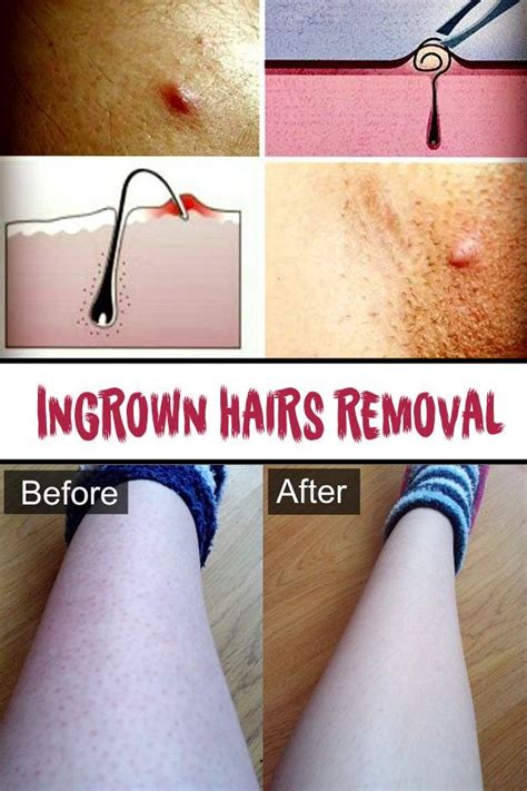 Ingrown hair comes by when tweezed or shaved hair grows back into the skin. Ingrown hairs removal #IngrownHairOnVagina | Ingrown hair ...