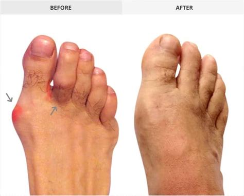 Bunion Surgery Before And After Gallery Bunion Institute La