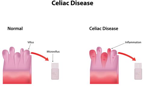 Diagram Diagram Of Celiac Disease Mydiagramonline