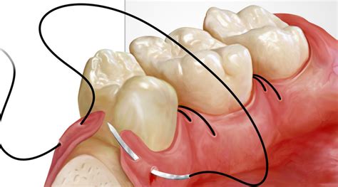 ¿en Qué Consiste El Uso De Puntos De Sutura En Odontología Estudi