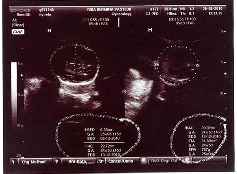 Gambar yang dihasilkan pun paling jelas khusus tes usg kehamilan, pasien dapat melihat kondisi janin melalui gambar pada layar monitor serta mendengar suara denyut janin secara. Cara Membaca Hasil Usg Jenis Kelamin