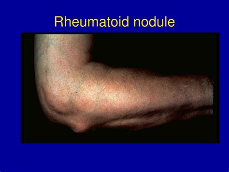 Ppt Rheumatoid Arthritis Powerpoint Presentation Free Download Id