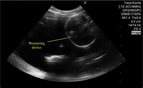 Ultrasound Guided Gastrostomy Tube Placement A Case Series Journal