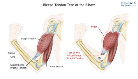 The two most common types of tendinitis are on the inside or outside of your elbow. Biceps Tendon Tear at the Elbow | Rehab My Patient