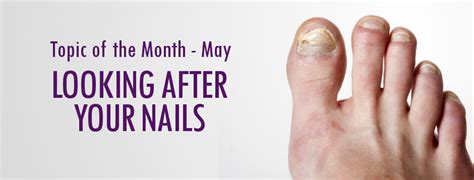 Taking Care Of Your Nails Lupus Uk Lupus Uk You Nailed It Nail