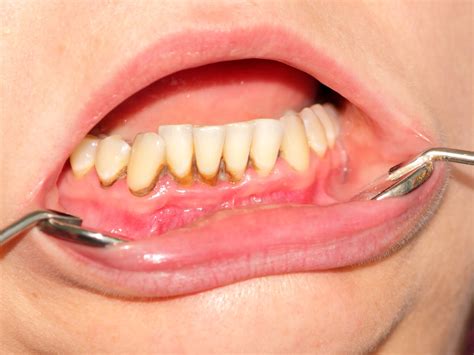 Can You Scrape Tartar Off Your Teeth