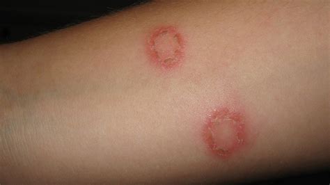 Ringworm Causes Symptoms Treatment And Medication