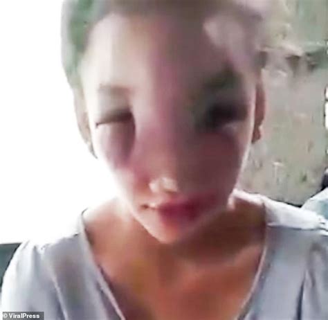 Teenage Mother Left With Huge Facial Swelling After Squeezing A Spot On