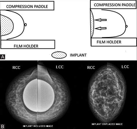 Breast Cancer Screening And Implants