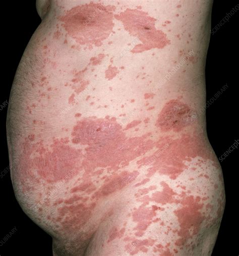 Plaque Psoriasis Stock Image C0575152 Science Photo Library