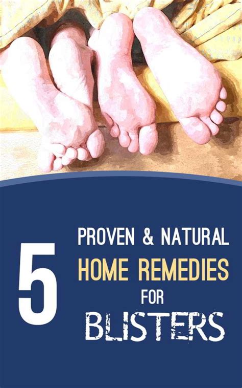 5 Safe And Natural Home Remedies For Blisters