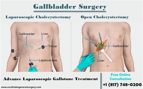 Signs That You Should Need Gallbladder Surgery Southlake General