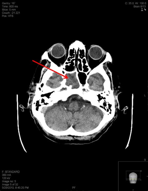 Axial View Of Brain Material Within The Right Side Of The Sphenoid