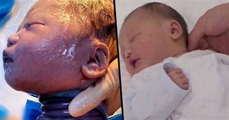 Miracle Baby Born With Umbilical Cord Wrapped Around His Neck Six Times